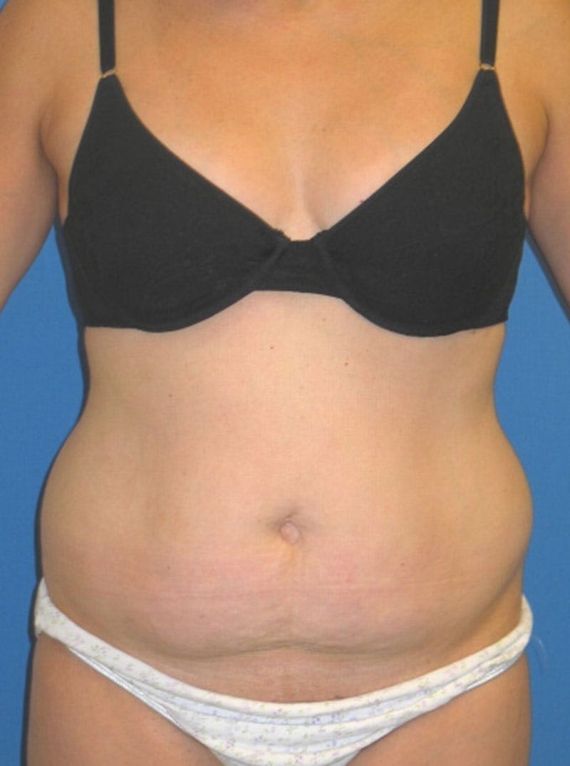 Abdominoplasty Before & After Gallery - Patient 175173254 - Image 1