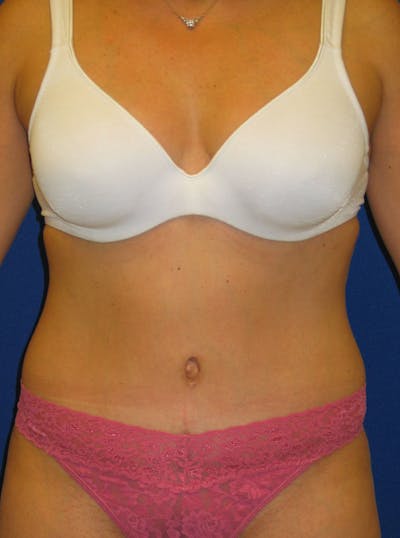 Abdominoplasty Before & After Gallery - Patient 175173254 - Image 2