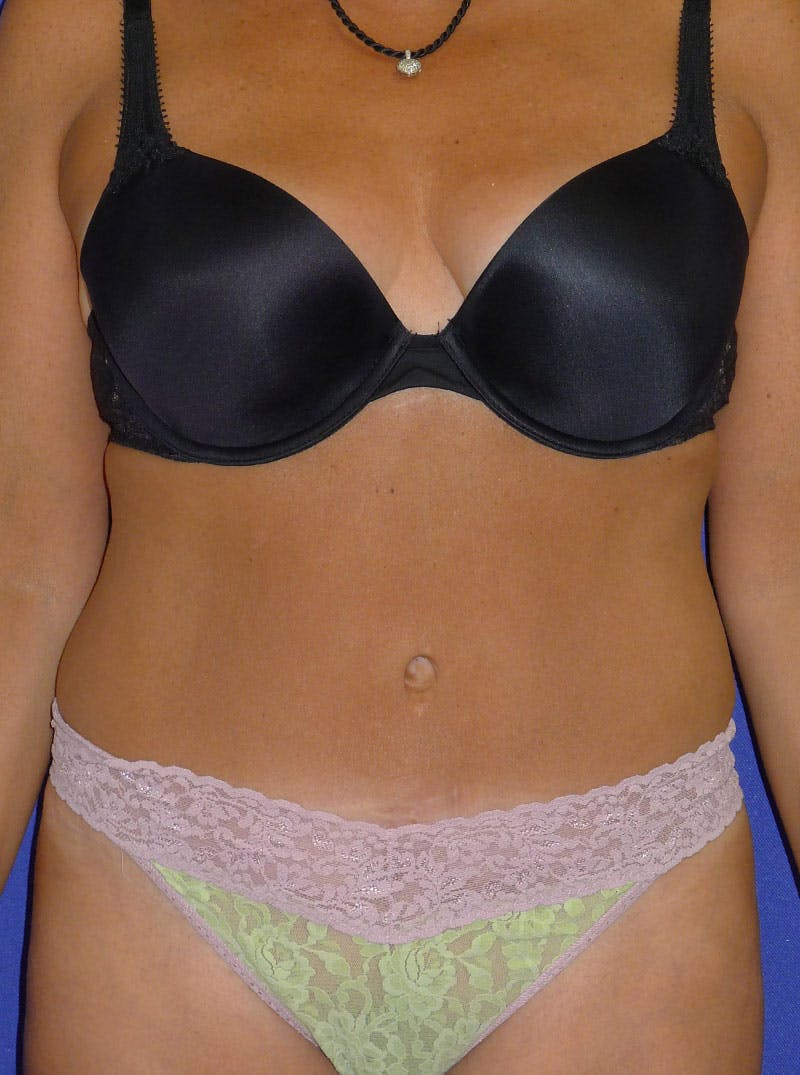 Abdominoplasty Before & After Gallery - Patient 175173254 - Image 10