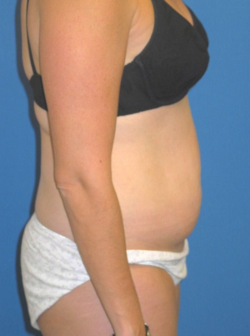 Liposuction Before & After Gallery - Patient 175180754 - Image 3