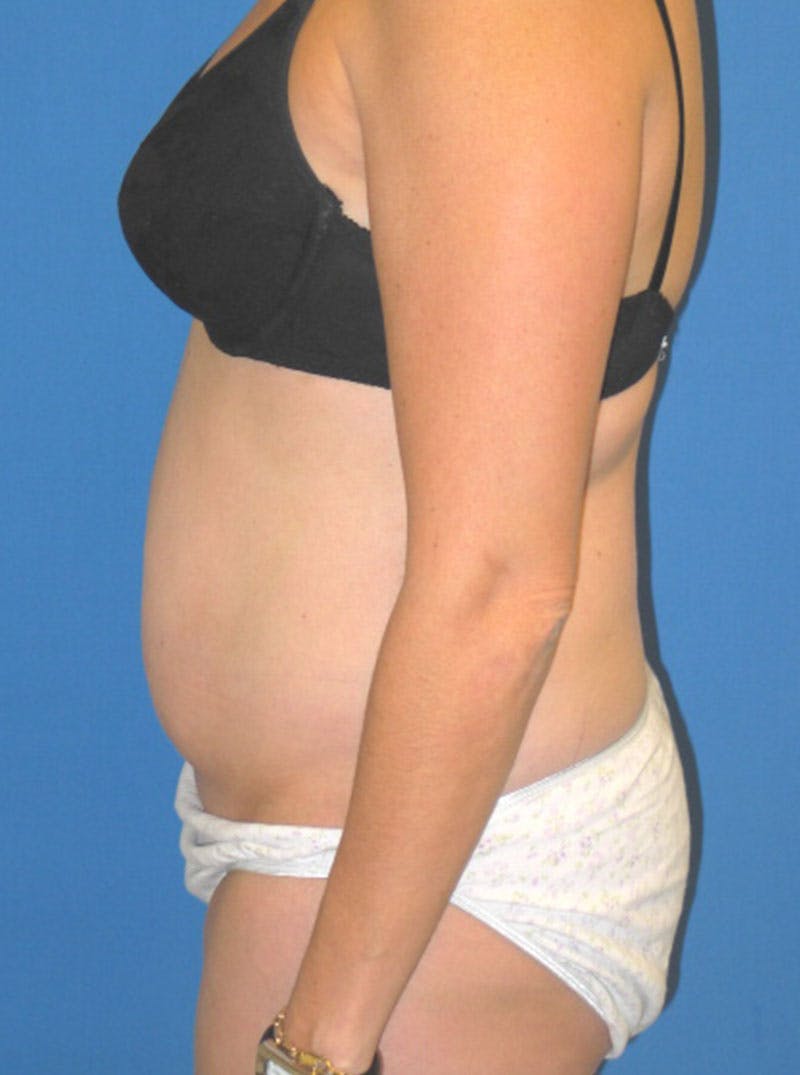 Liposuction Before & After Gallery - Patient 175180754 - Image 5