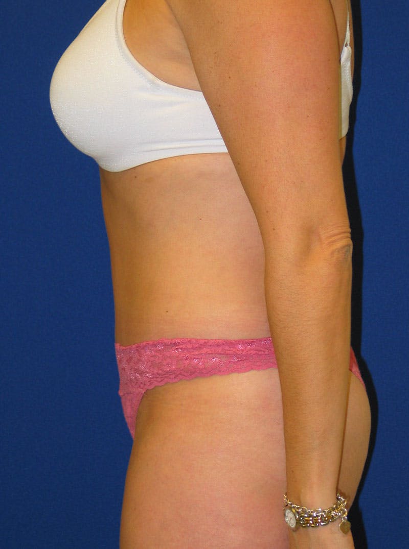 Liposuction Before & After Gallery - Patient 175180754 - Image 6