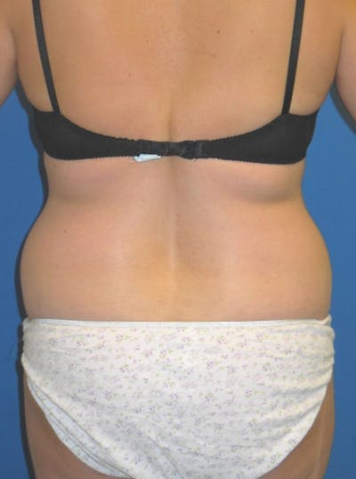 Liposuction Before & After Gallery - Patient 175180754 - Image 1