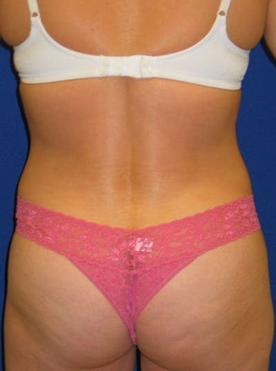 Liposuction Before & After Gallery - Patient 175180754 - Image 2