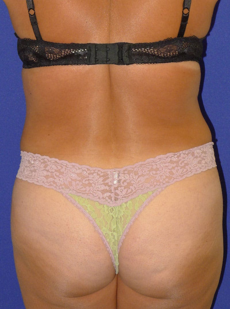 Liposuction Before & After Gallery - Patient 175180754 - Image 8