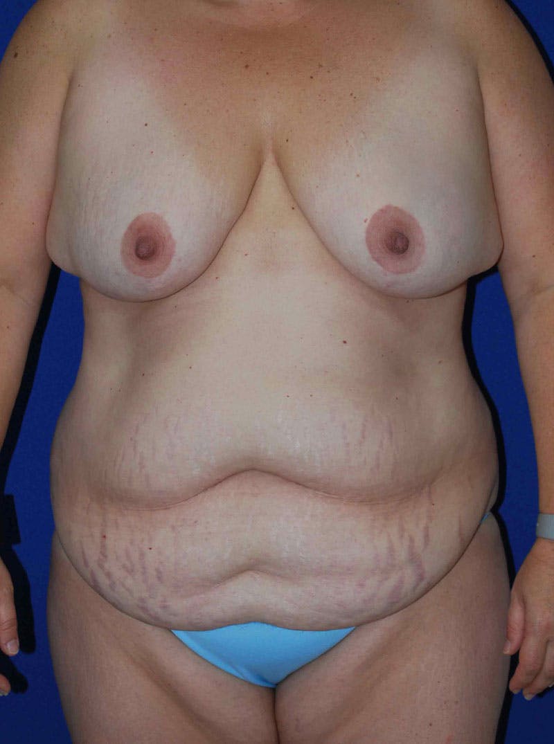 Mommy Makeover Before & After Gallery - Patient 175180757 - Image 1