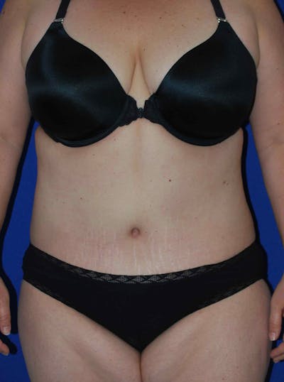 Mommy Makeover Before & After Gallery - Patient 175180757 - Image 2