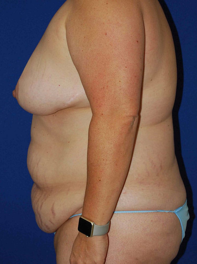 Mommy Makeover Before & After Gallery - Patient 175180757 - Image 3