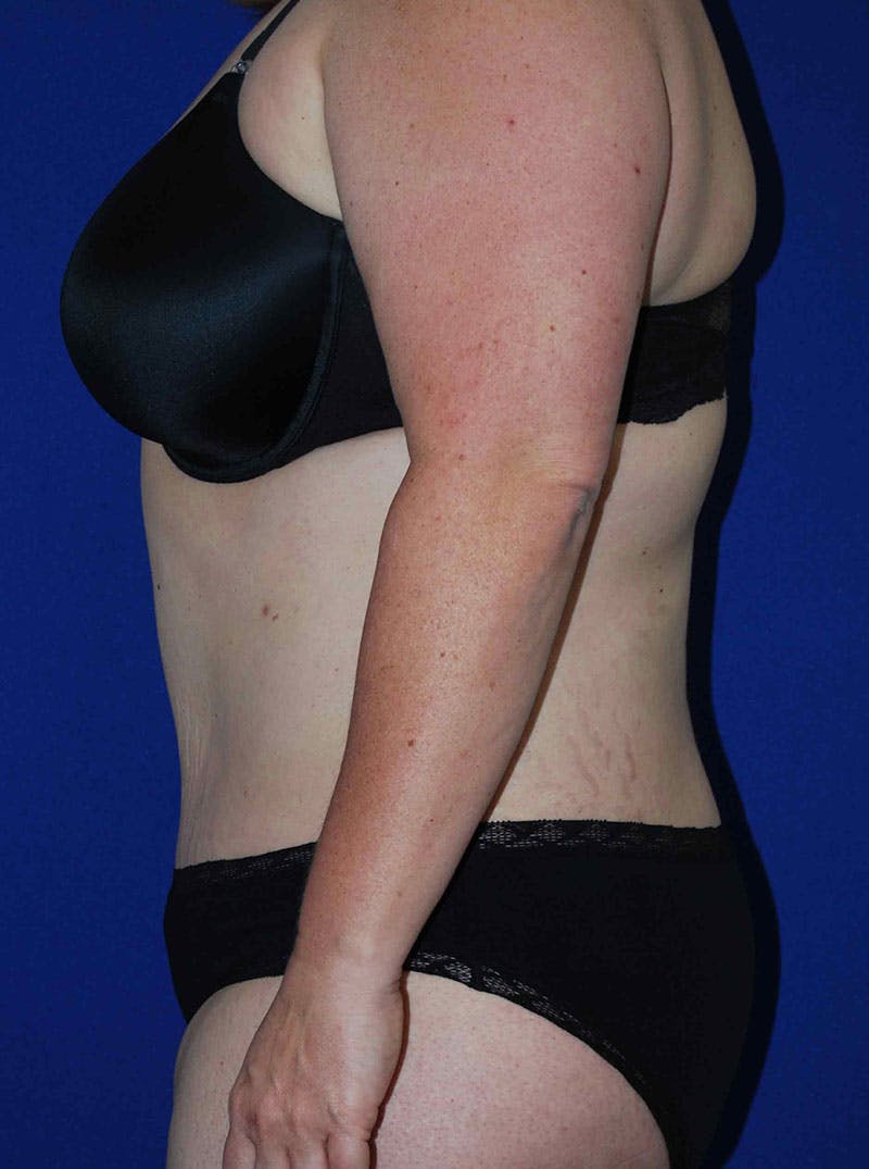 Mommy Makeover Before & After Gallery - Patient 175180757 - Image 4