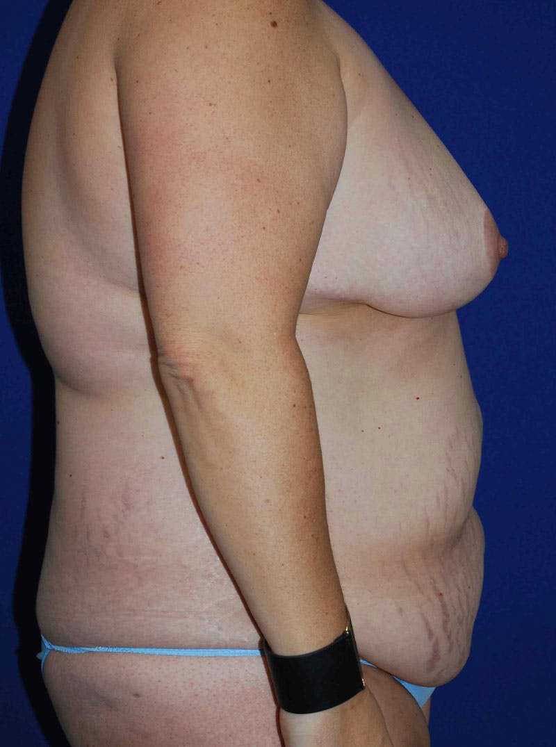 Mommy Makeover Before & After Gallery - Patient 175180757 - Image 5