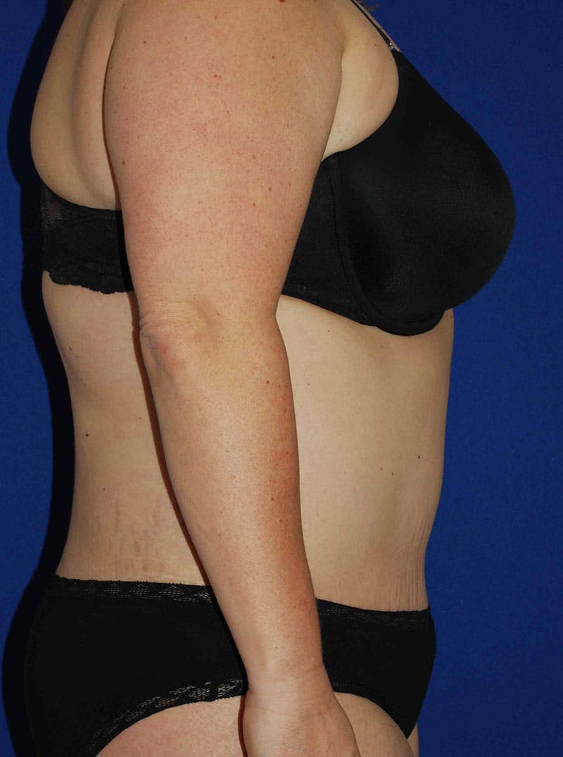 Mommy Makeover Before & After Gallery - Patient 175180757 - Image 6