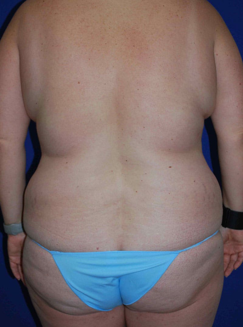 Mommy Makeover Before & After Gallery - Patient 175180757 - Image 7