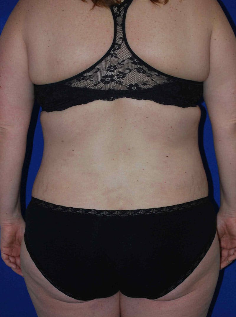 Mommy Makeover Before & After Gallery - Patient 175180757 - Image 8