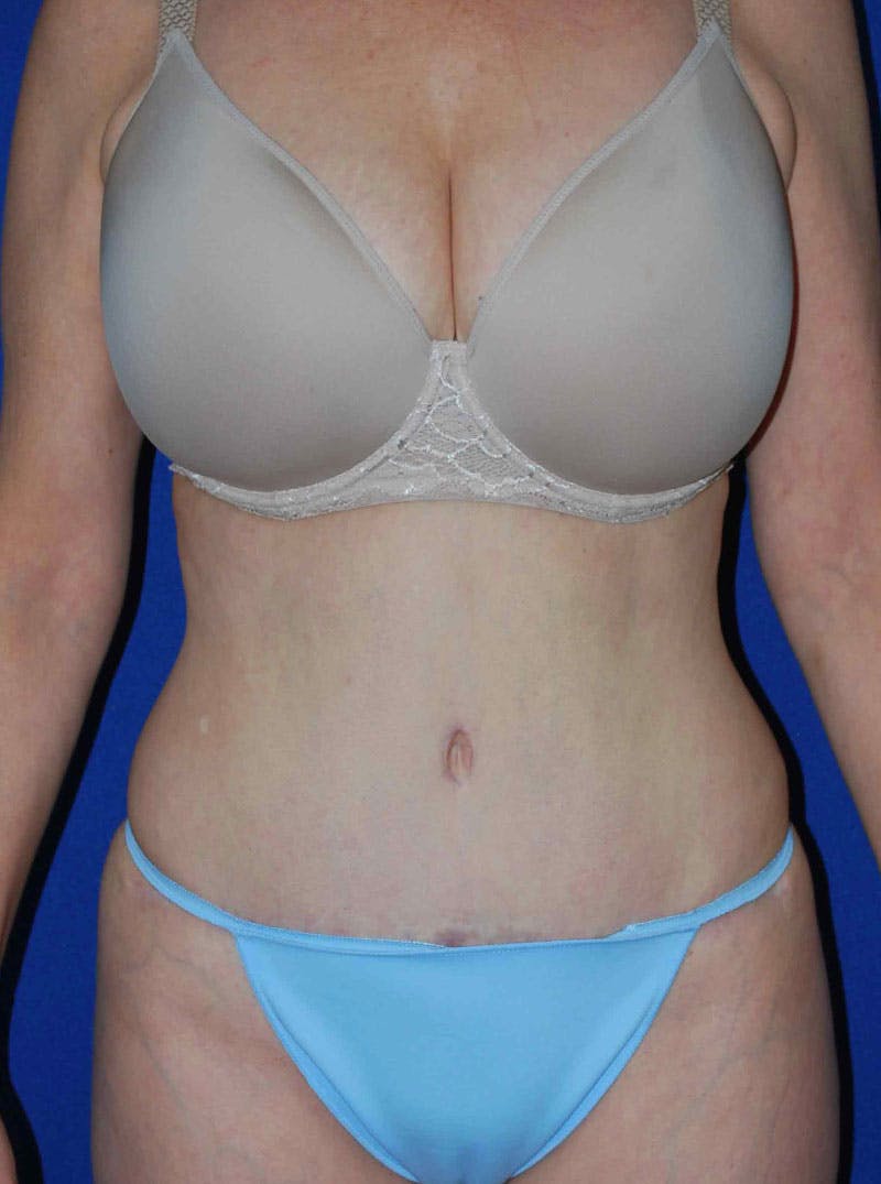 Abdominoplasty Before & After Gallery - Patient 175173279 - Image 2