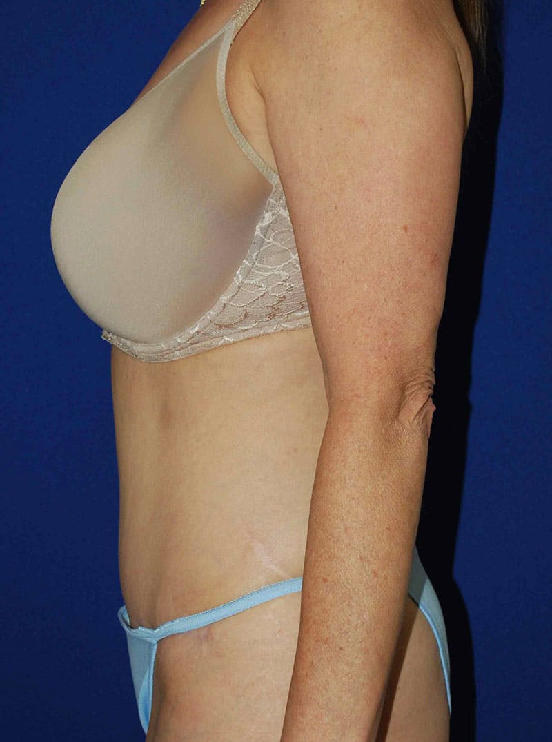 Abdominoplasty Before & After Gallery - Patient 175173279 - Image 4