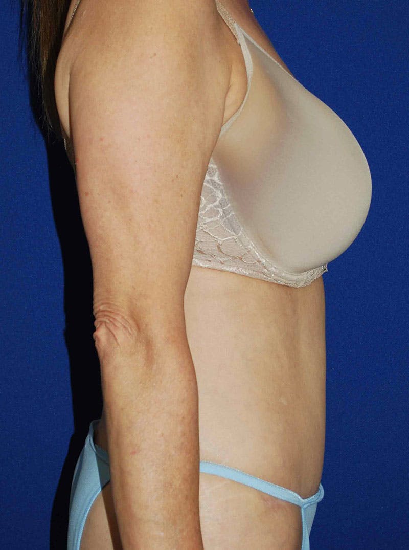 Abdominoplasty Before & After Gallery - Patient 175173279 - Image 6