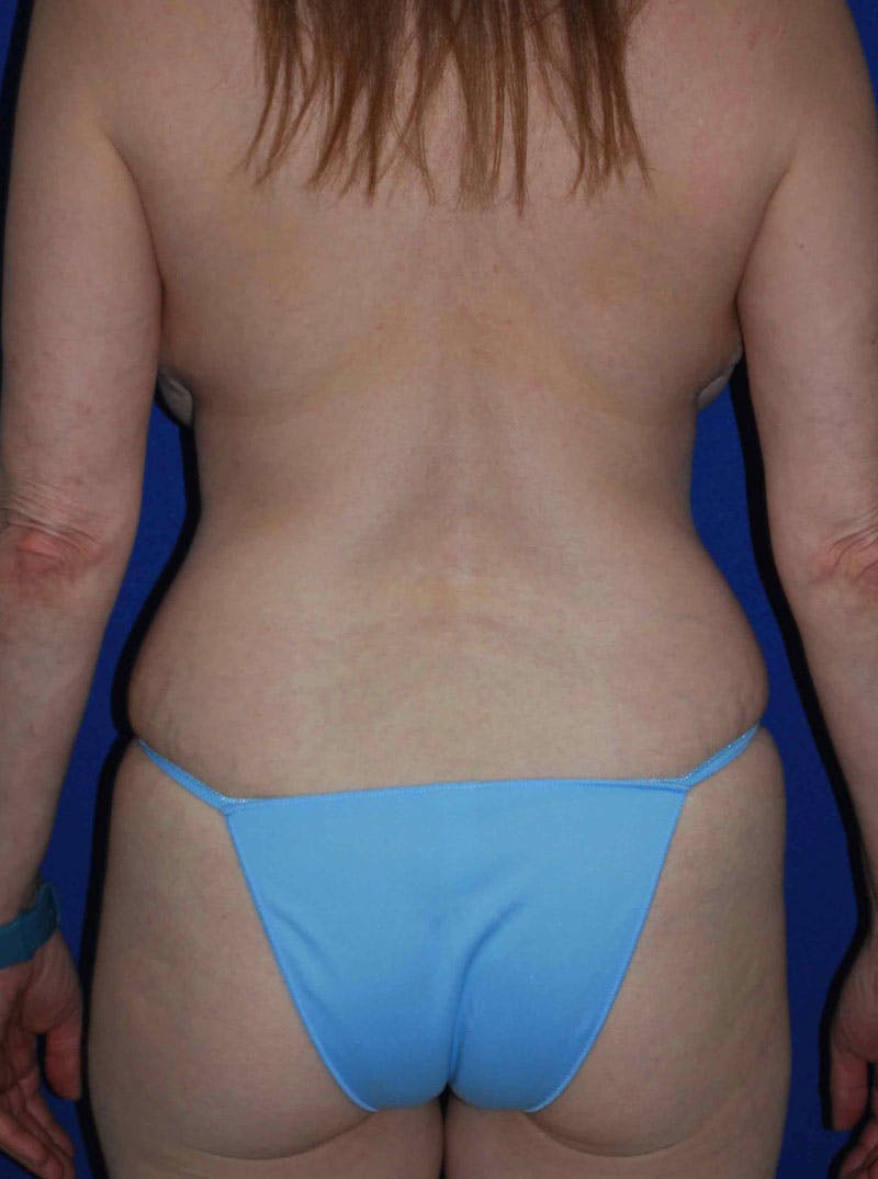 Abdominoplasty Before & After Gallery - Patient 175173279 - Image 7
