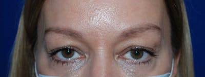 Blepharoplasty Before & After Gallery - Patient 175173321 - Image 1