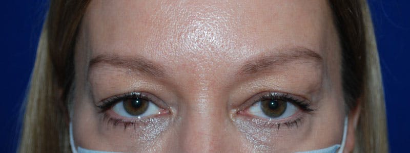 Blepharoplasty Before & After Gallery - Patient 175173321 - Image 1