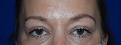 Blepharoplasty Before & After Gallery - Patient 175173321 - Image 2