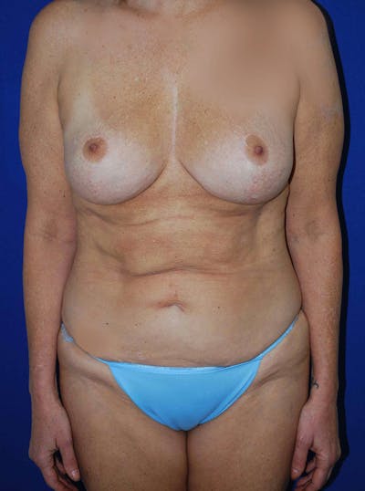 Mastopexy/Lift Before & After Gallery - Patient 175173999 - Image 1