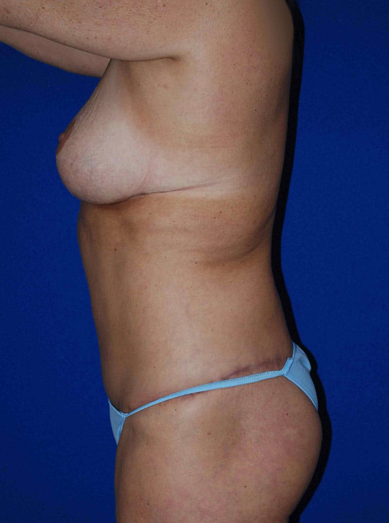 Mastopexy/Lift Before & After Gallery - Patient 175173999 - Image 6