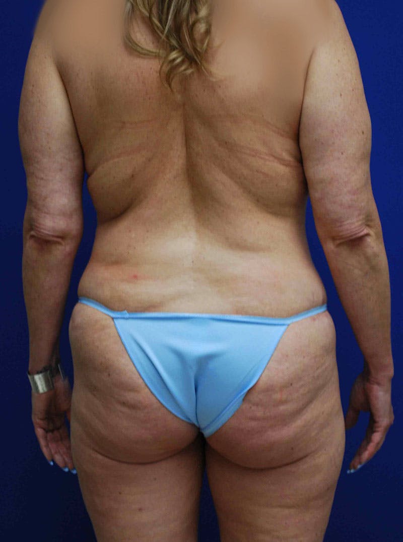 Circumferential Body Lift Before & After Gallery - Patient 175173379 - Image 7