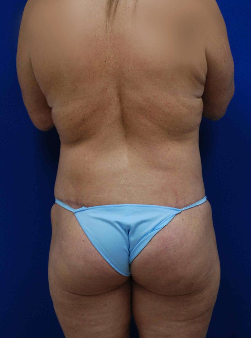 Circumferential Body Lift Before & After Gallery - Patient 175173379 - Image 8