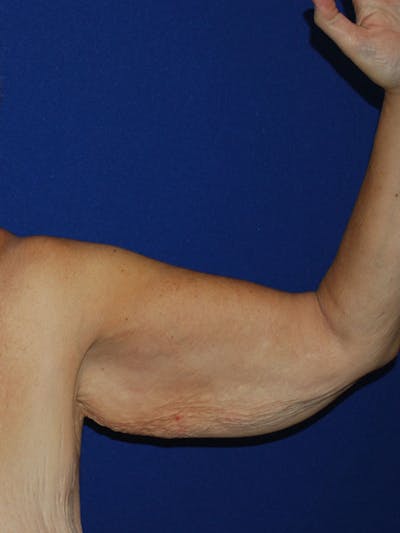 Brachioplasty Before & After Gallery - Patient 175174013 - Image 1