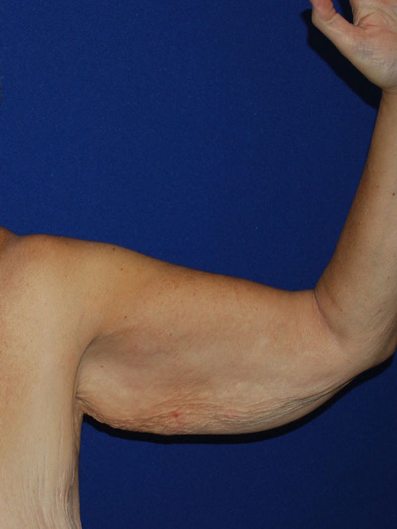 Brachioplasty Before & After Gallery - Patient 175174013 - Image 1