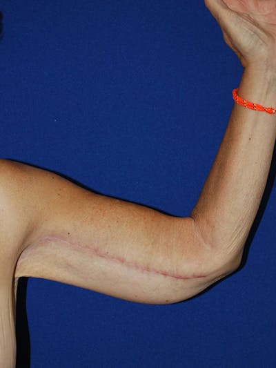Brachioplasty Before & After Gallery - Patient 175174013 - Image 2