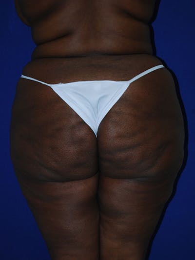 Liposuction Before & After Gallery - Patient 175180750 - Image 1