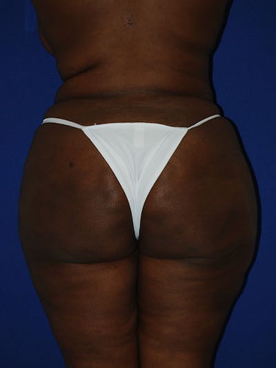 Liposuction Before & After Gallery - Patient 175180750 - Image 2