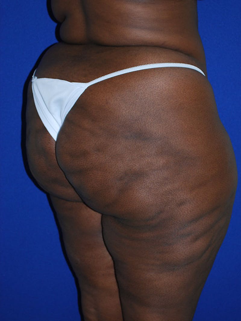 Liposuction Before & After Gallery - Patient 175180750 - Image 3