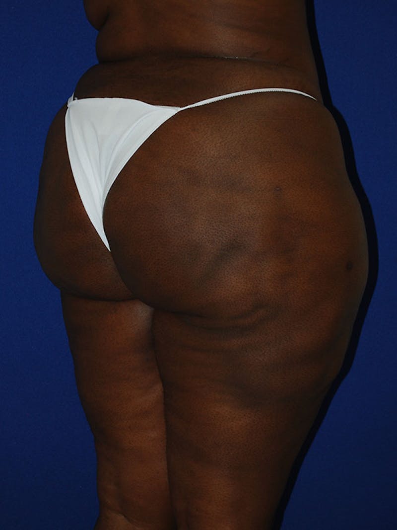 Liposuction Before & After Gallery - Patient 175180750 - Image 4