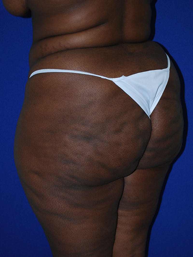 Liposuction Before & After Gallery - Patient 175180750 - Image 5