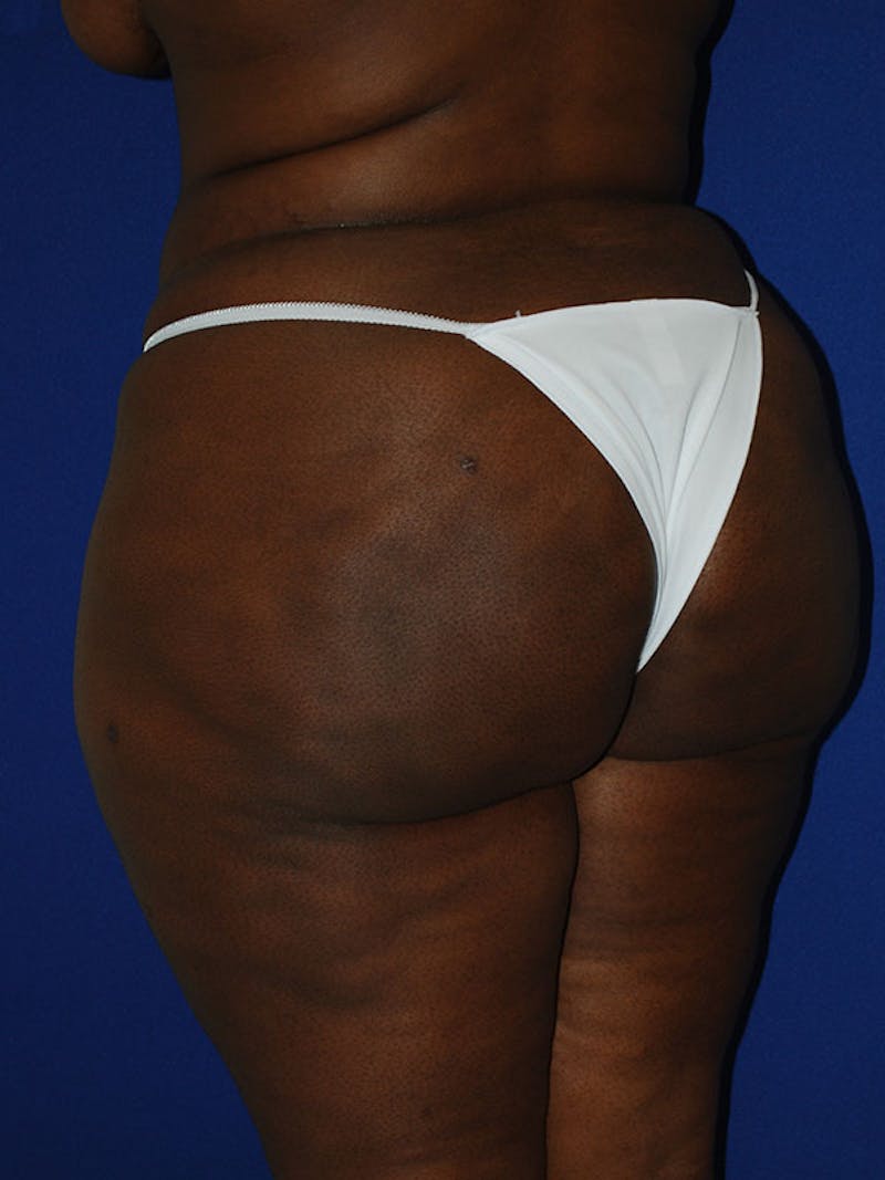 Liposuction Before & After Gallery - Patient 175180750 - Image 6