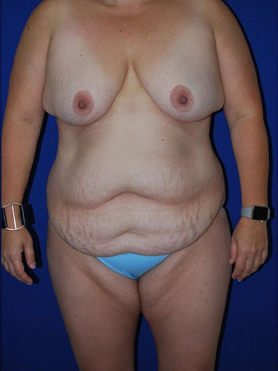 Umbilicus Before & After Gallery - Patient 175174490 - Image 1