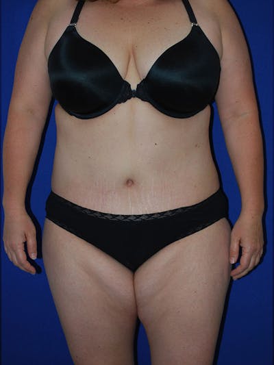 Umbilicus Before & After Gallery - Patient 175174490 - Image 2