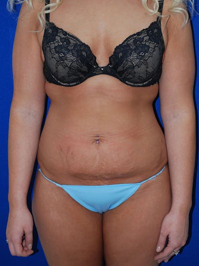 Mommy Makeover Before & After Gallery - Patient 175180755 - Image 1