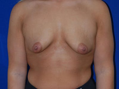 Augmentation Before & After Gallery - Patient 175175678 - Image 1