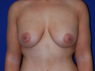 Augmentation Before & After Gallery - Patient 175175678 - Image 2