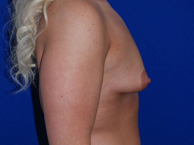 Augmentation Before & After Gallery - Patient 175175678 - Image 3