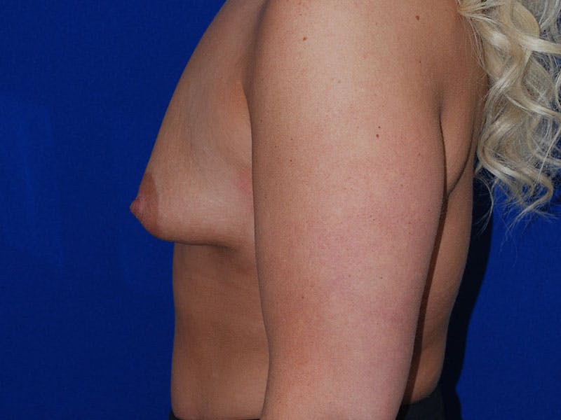 Augmentation Before & After Gallery - Patient 175175678 - Image 5