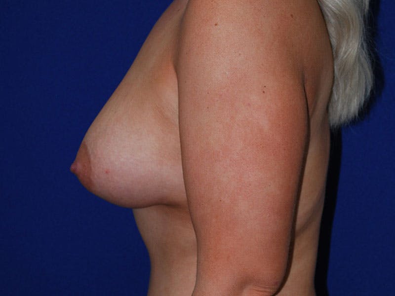 Augmentation Before & After Gallery - Patient 175175678 - Image 6