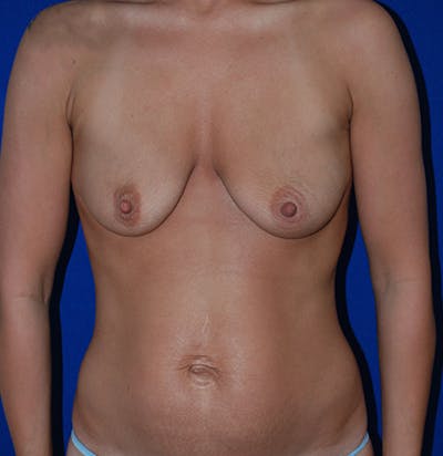 Augmentation Before & After Gallery - Patient 175183798 - Image 1