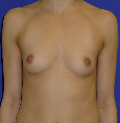 Augmentation Before & After Gallery - Patient 175183686 - Image 1