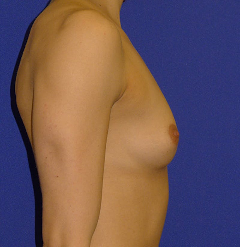 Augmentation Before & After Gallery - Patient 175183686 - Image 3
