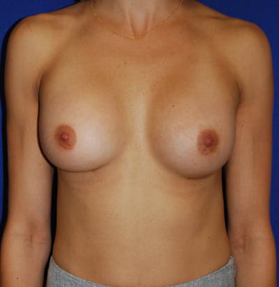 Augmentation Before & After Gallery - Patient 175183686 - Image 2
