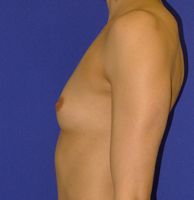 Augmentation Before & After Gallery - Patient 175183686 - Image 5